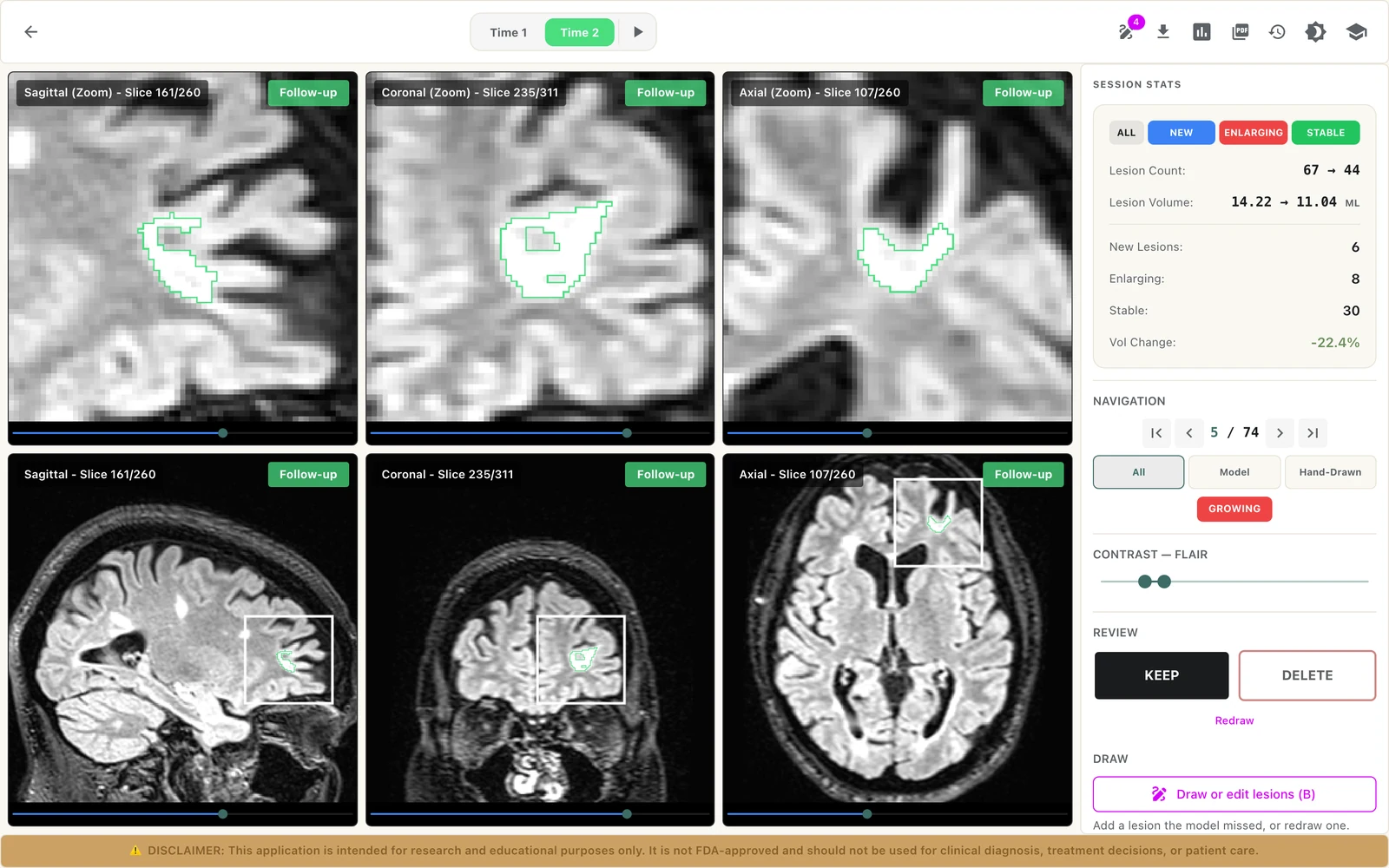 LAMINATE longitudinal review: sagittal, coronal, and axial FLAIR views of a follow-up scan with lesion outlines, beside session statistics for new, enlarging, and stable lesions